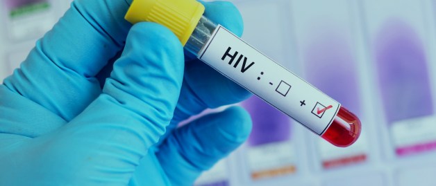 Ein Arzt hält eine Blutprobe in der Hand, auf der ein HIV-Testergebnis abgebildet ist. Der Test ist positiv.