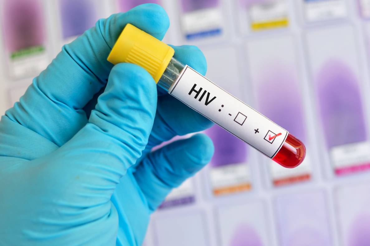 Eine Hand, die einen Gummihandschuh trägt, hält ein Reagenzglas. Darauf klebt ein Aufkleber mit der Aufschrift HIV und zwei Kästchen, die HIV negativ und HIV positiv andeuten. Das Kästchen bei HIV positiv ist angekreuzt.