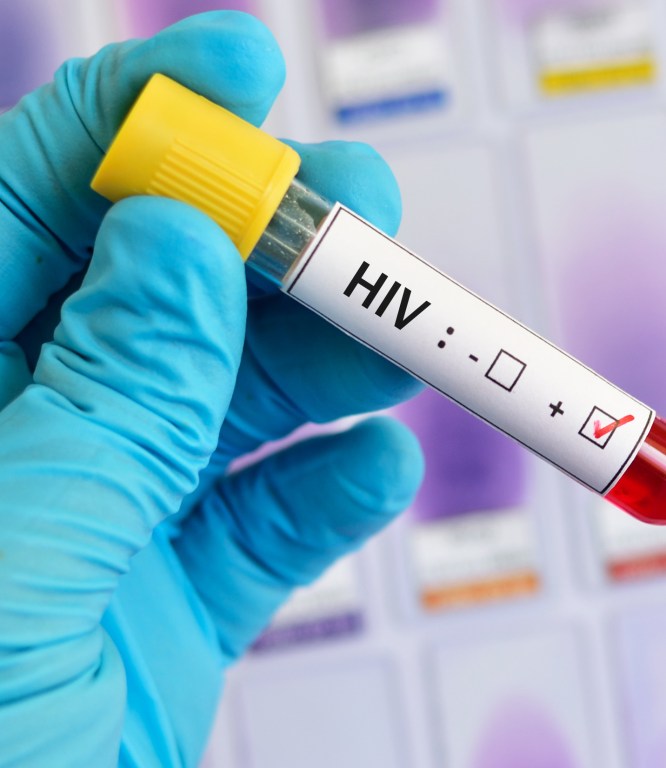 Eine Hand, die einen Gummihandschuh trägt, hält ein Reagenzglas. Darauf klebt ein Aufkleber mit der Aufschrift HIV und zwei Kästchen, die HIV negativ und HIV positiv andeuten. Das Kästchen bei HIV positiv ist angekreuzt.